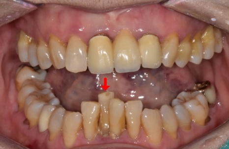 솟구치는 앞니, 흔들리는 치아가 보내는 관련 이미지 6