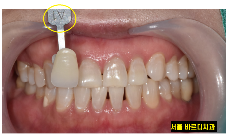 상일동 치아 미백 결혼 전 받아야하는 이유 3가지 관련 이미지 6