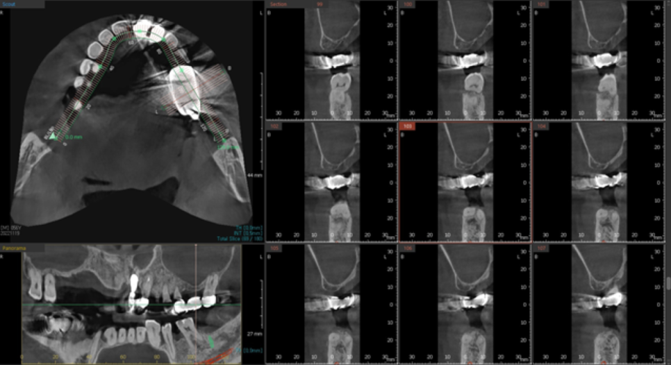 고덕동치과 서울바르디치과 전치부 및 구치부 임플란트 치료증례 #9 관련 이미지 20