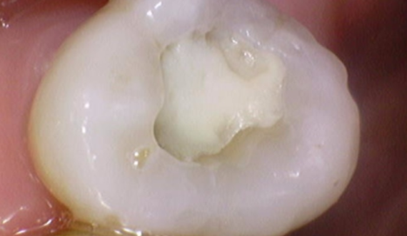 미사역 치과 어금니 뿌리 쪼개짐으로 발치 후 임플란트 했습니다! 관련 이미지 4