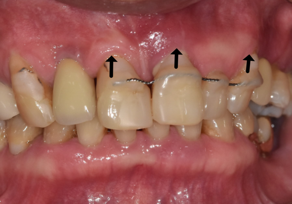 앞니 흔들림, 임플란트 치아보험 감액 기간 넘기려다 더 큰 손해 봅니다. 관련 이미지 2