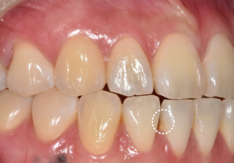 앞니 라미네이트, 치아 시림 고민 덜 수 있는 해결 방법 공개합니다. 관련 이미지 6