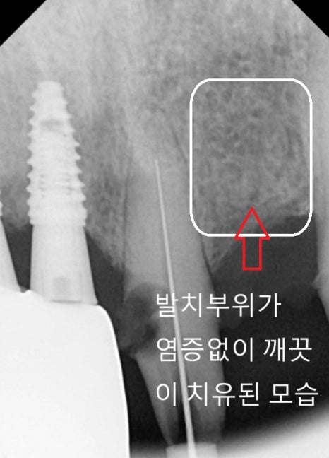 고덕역 임플란트, 뼈이식 꼭 해야 할까? 필수 상황 vs 제외 상황 총정리 관련 이미지 1