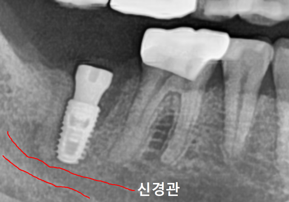 강동구 임플란트 기간, 사람마다 왜 다를까? 즉시식립과 지연식립의 결정적 차이 관련 이미지 9