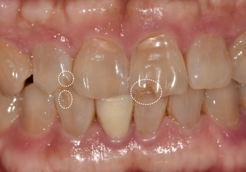 앞니 깨짐 치료 비용, 더이상 치과에 돈 낭비하기 싫다면? 깨지는 원인부터 알아야 합니다. 관련 이미지 10