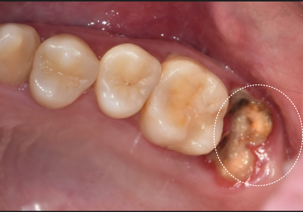 If you lightly brush your backmost molar because the toothbrush can’t reach it, this is what happens. image 4