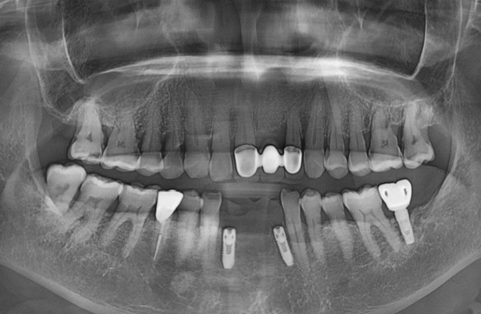 솟구치는 앞니, 흔들리는 치아가 보내는 관련 이미지 11