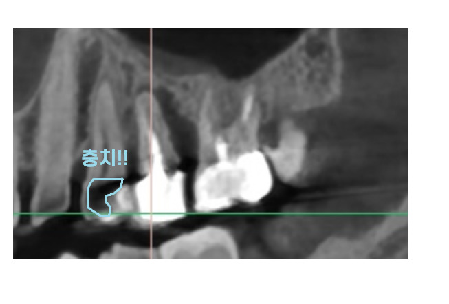 덕풍동 치과 씹을때 통증 임플란트로 극복했습니다. 관련 이미지 9