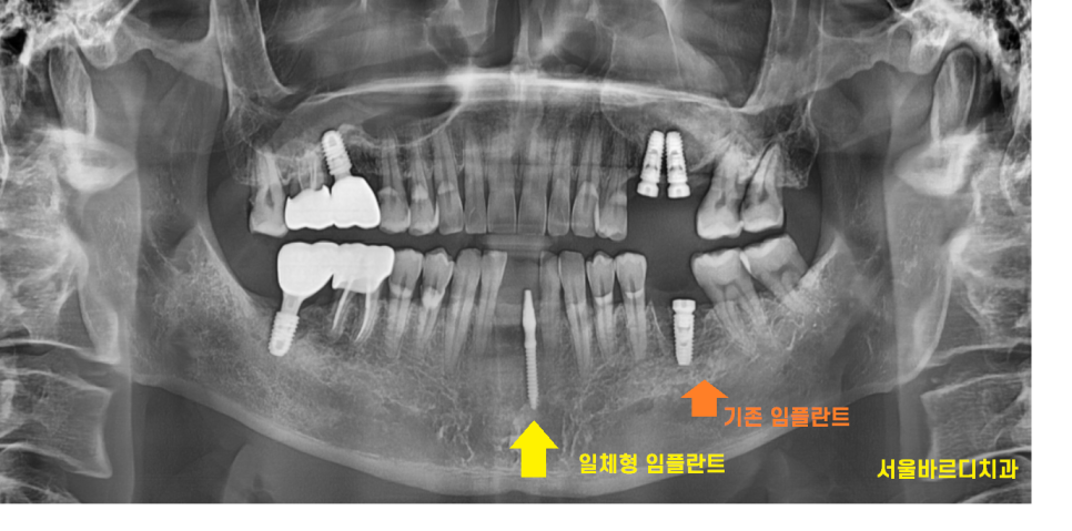 둔촌동 치과 아래 앞니 임플란트 뼈가 없을 때 일체형으로! 관련 이미지 7