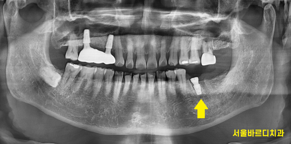 신경치료 후 통증 치아 뿌리 금으로 발치 후 강일역 임플란트 관련 이미지 6
