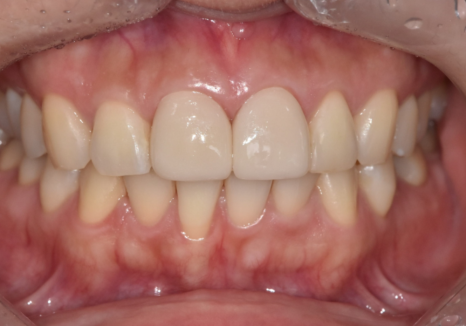 강일역 치과, 검게 보이는 앞니 레진 변색, 무조건 새로 해야 할까요? 관련 이미지 12