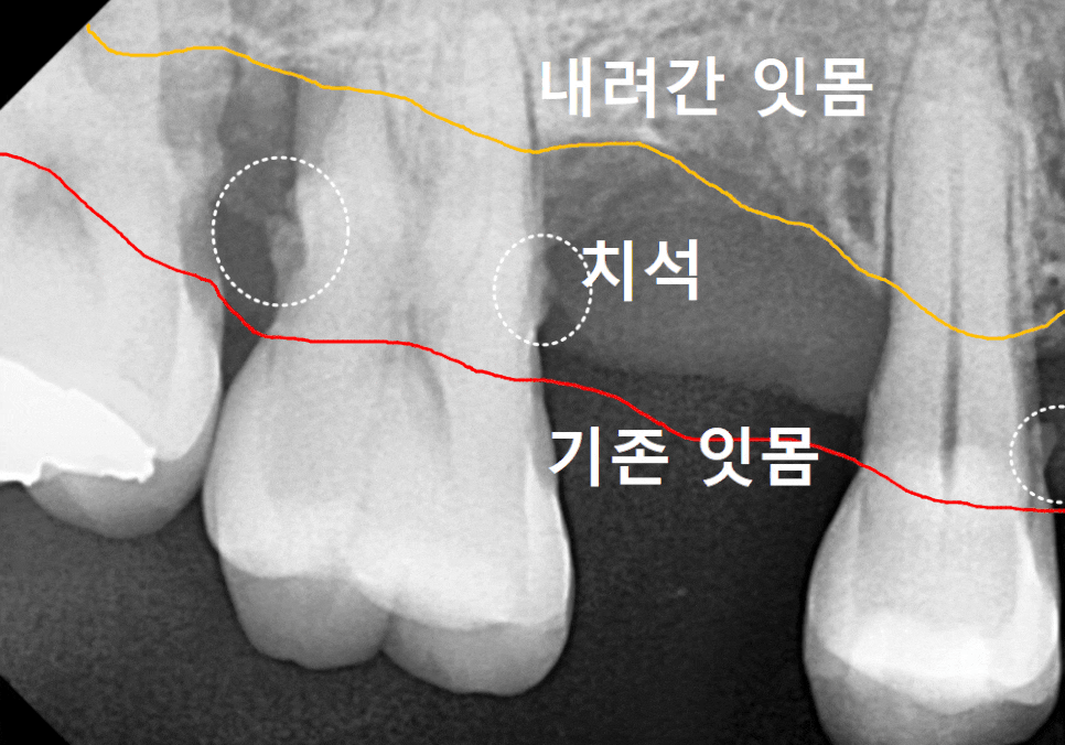 고덕동 스케일링 미루다 앞니 어금니 다 뽑고 임플란트 했습니다. 관련 이미지 10
