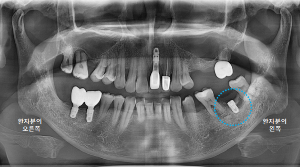 고덕동치과 서울바르디치과 전치부 및 구치부 임플란트 치료증례 #9 관련 이미지 13