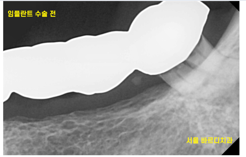 미사역 치과 건강보험 임플란트 혜택이 가능한 병원입니다. 관련 이미지 7