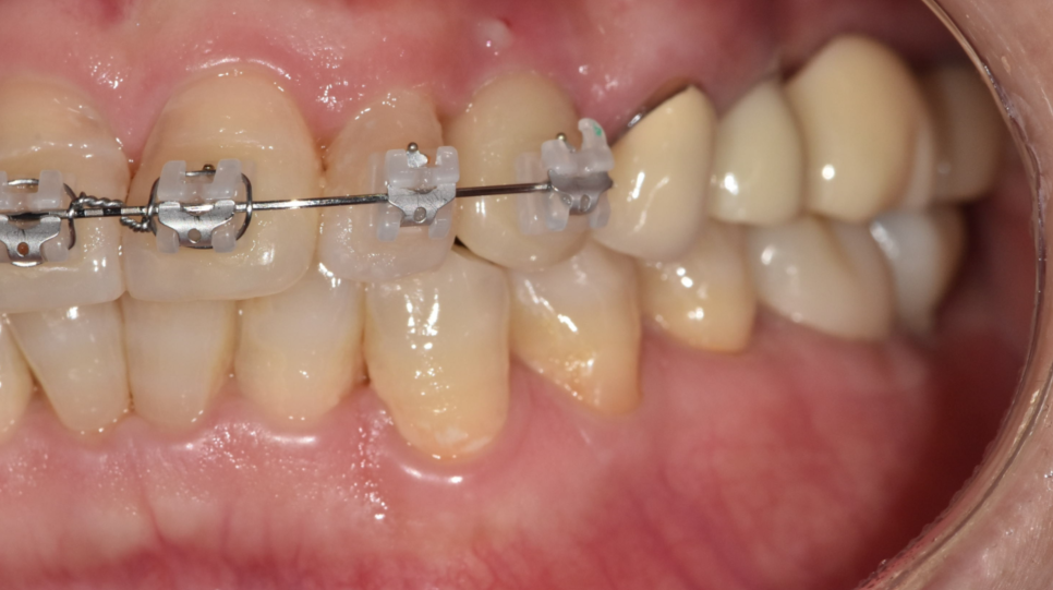 Orthodontic Bracket Debonding: Please Pay Attention If You Have Many Prosthetic Restorations image 3