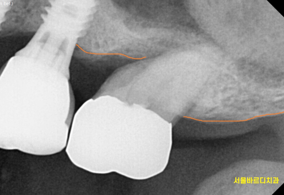 미사역 임플란트 잇몸이 풍선처럼 부풀어오르는 치주농양 환자분 관련 이미지 6