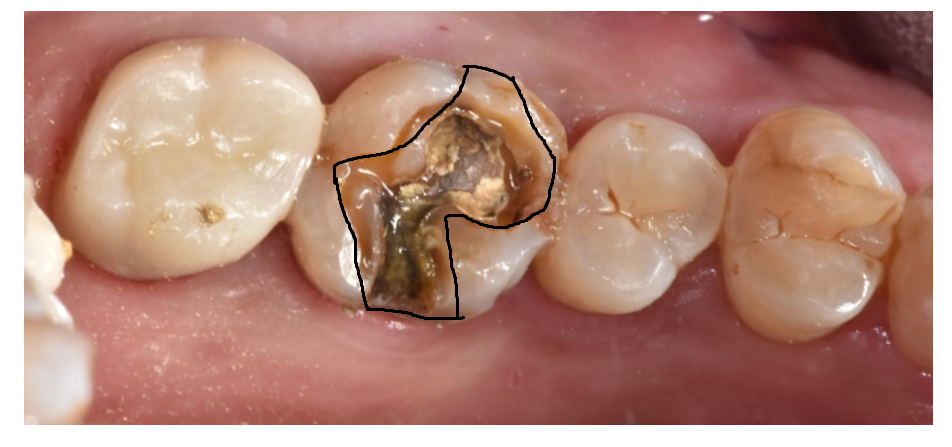 치아 사이 충치 원데이 인레이 하루만에 끝낼 수가 있을까? 관련 이미지 2
