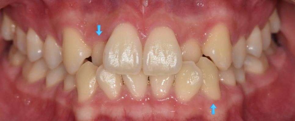 앞니 덧니 때문에 웃기 불편하다면? 상일동에서 치아교정 솔루션 관련 이미지 2