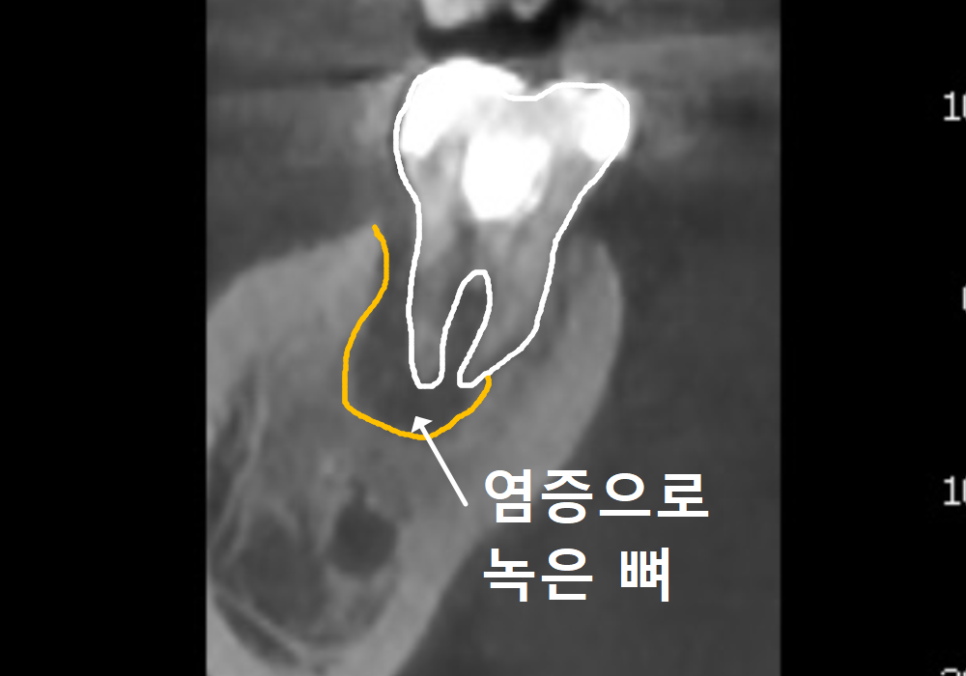 어금니 염증, 자연치 살리기에 진심인 저는 이렇게 살렸습니다. 관련 이미지 7