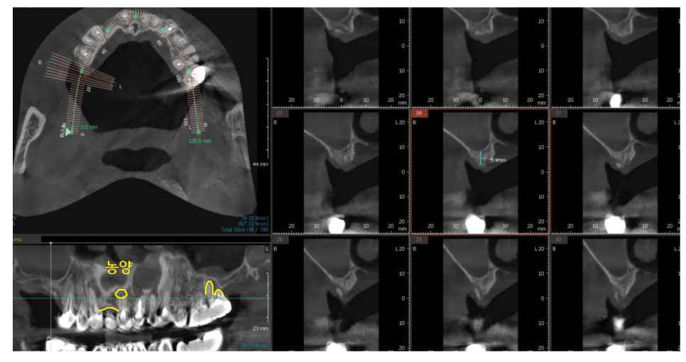명일동 치과 뿌리 염증으로 입냄새가 나요 해결책은? 관련 이미지 6