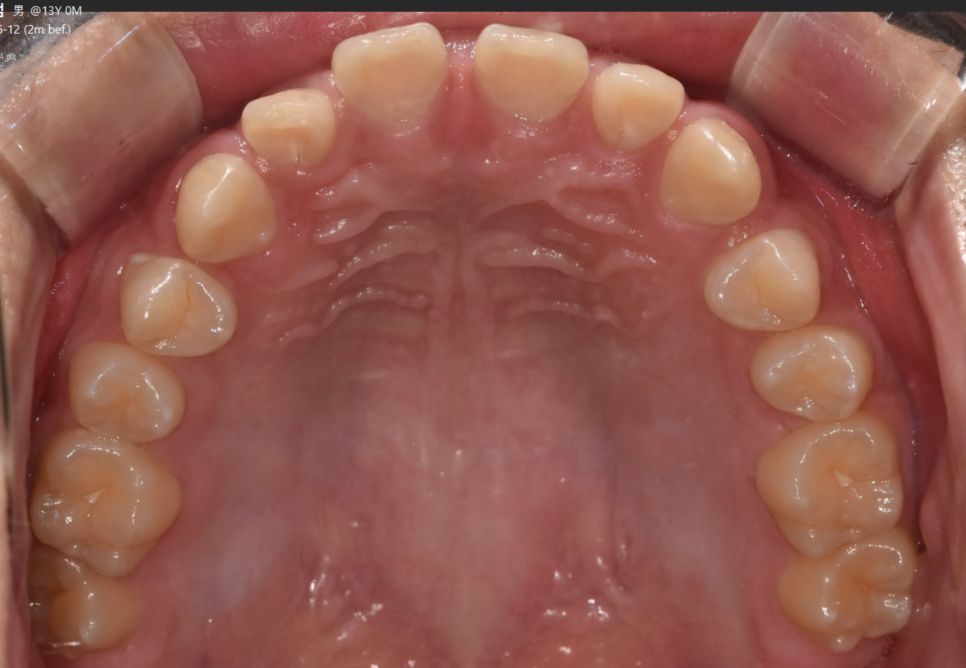 벌어진 앞니 치아 교정 통해 공간 닫기 장점이 많습니다. 관련 이미지 4