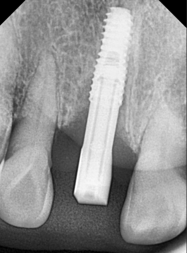 앞니 길어짐, 위 앞니가 점점 내려온다면? 관련 이미지 13