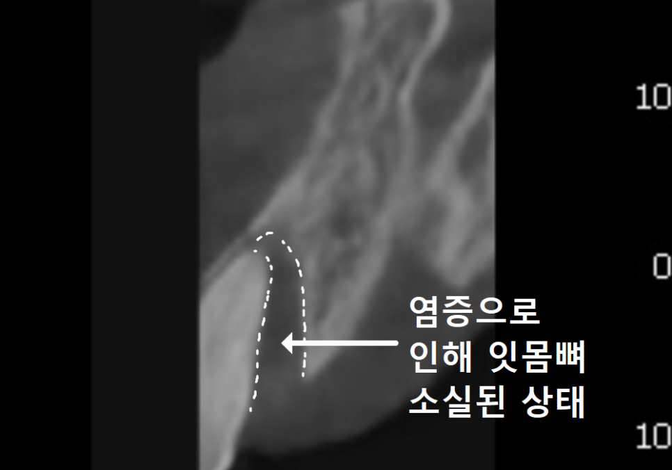 앞니 길어짐, 위 앞니가 점점 내려온다면? 관련 이미지 8
