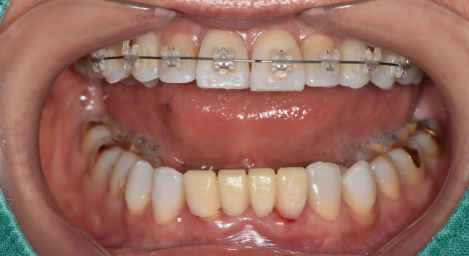 치아교정 재교정 다시 삐뚤어진 치아 원인과 해결방법은? 관련 이미지 4