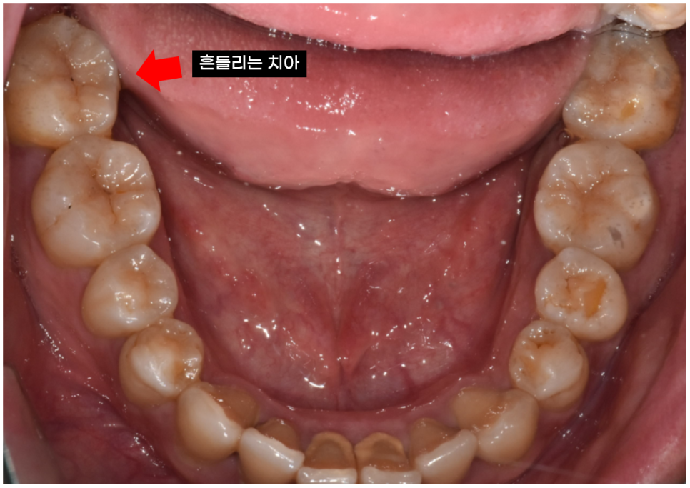 신경 임플란트 가까울때 안전하게 심을 수 있는 지연 식립법 공개 관련 이미지 4