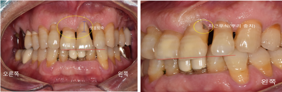 상일동치과 서울바르디치과 무절개 네비게이션 임플란트 치료증례 #3 관련 이미지 2