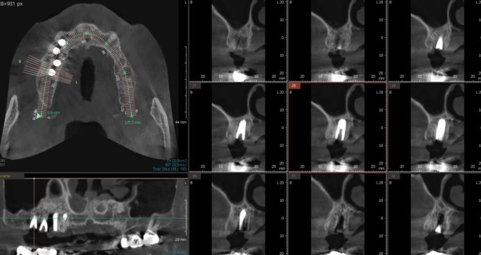 풍산동 치과 임플란트 시술후 통증 부작용은 아닐까? 관련 이미지 7
