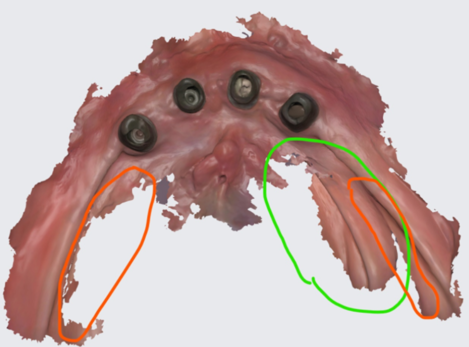 추석 효도선물로 임플란트 하세요 치아 없으면 최소 10년은 손해봅니다. 관련 이미지 3