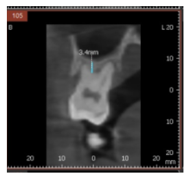 길동 치과 임플란트 뼈이식 후 흡연 상관 있을까? 관련 이미지 5