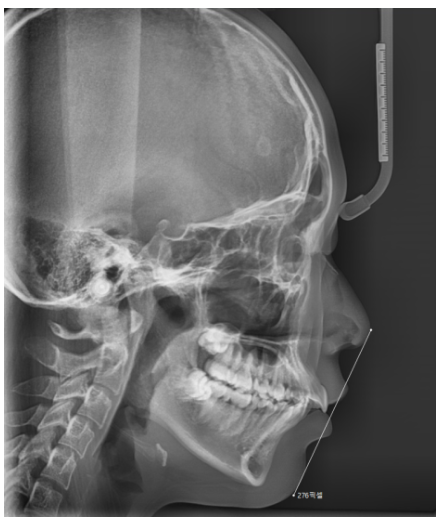 강동구 치아교정 아이들 방학 때 시작하면 좋은 이유 관련 이미지 1
