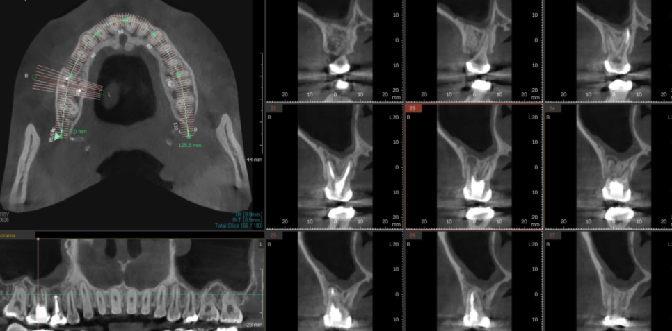 망월동 치과 재신경치료 자연치아 살리기 끝판왕 치료 mta로 가능했습니다. 관련 이미지 5