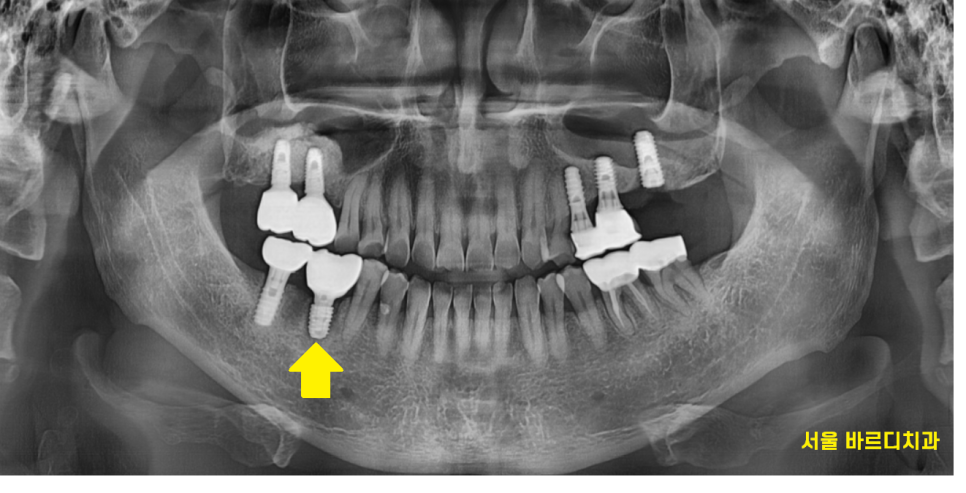 미사역 임플란트 잇몸이 풍선처럼 부풀어오르는 치주농양 환자분 관련 이미지 7