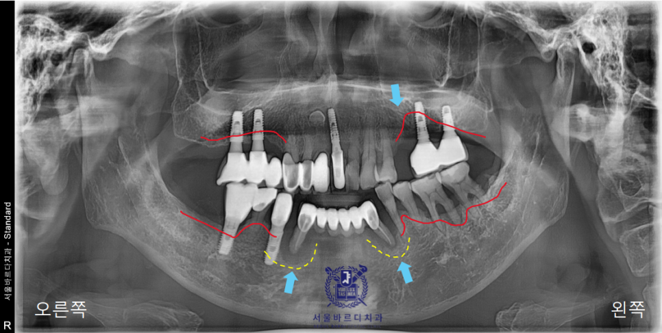 고덕동치과 서울바르디치과 전치부 및 구치부 임플란트 치료증례 #10 관련 이미지 1