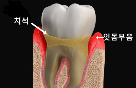 스케일링했더니 잇몸 구멍, 치아 사이 구멍이 생겼어요. 스케일링에 관한 오해 3가지 관련 이미지 7
