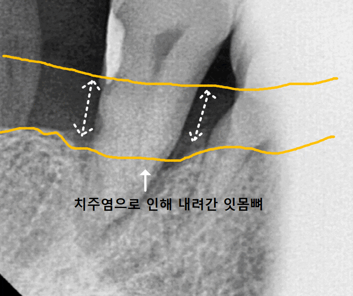 크라운 탈락 빠짐, 빠졌을 때 그대로 다시 붙일 수 있나요? 관련 이미지 9