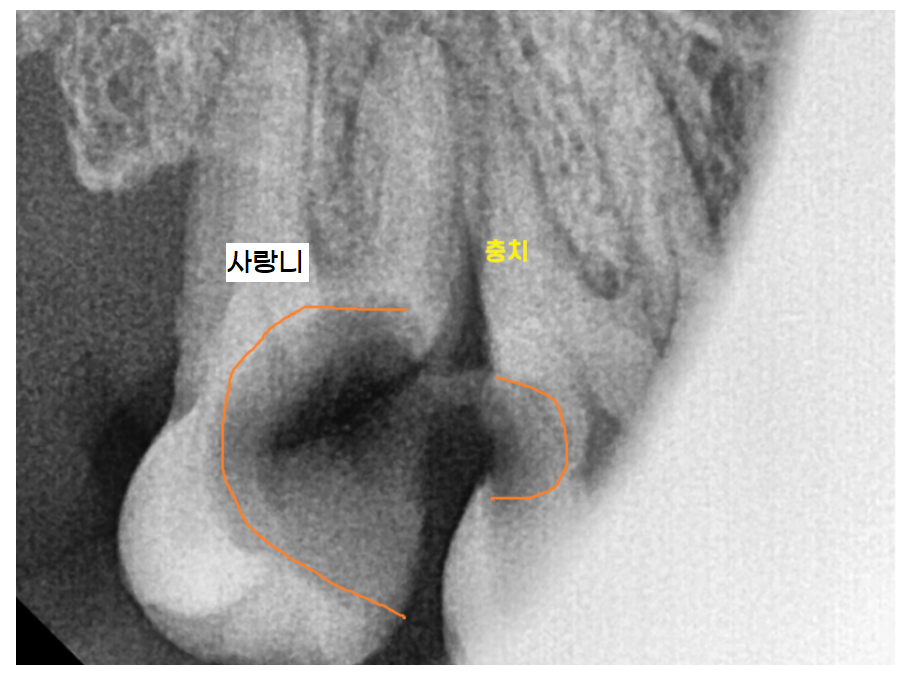 치아 교정 중 사랑니 뽑아야할까?? 관련 이미지 4