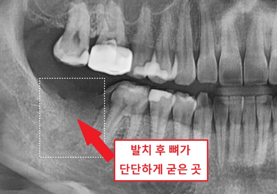 강일역 치과, 위 아래 앞니 임플란트 기간, 얼마나 걸리나요? 관련 이미지 2