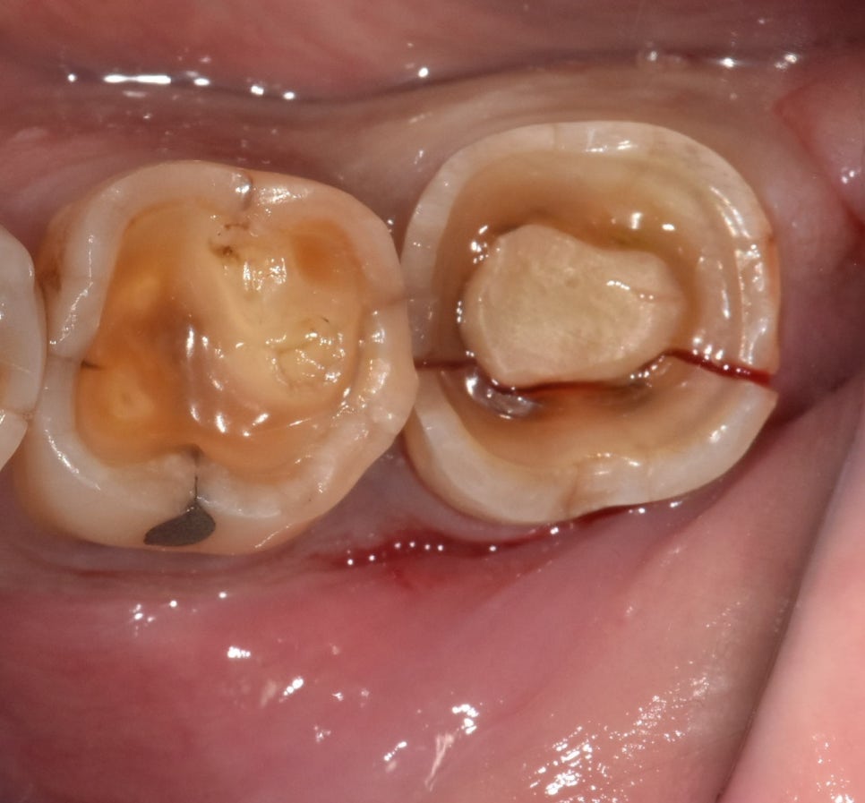 Implant Treatment for a Fractured Molar Split in Half After Neglect Following Root Canal Treatment image 3