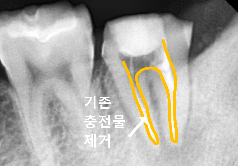 어금니 염증, 자연치 살리기에 진심인 저는 이렇게 살렸습니다. 관련 이미지 9