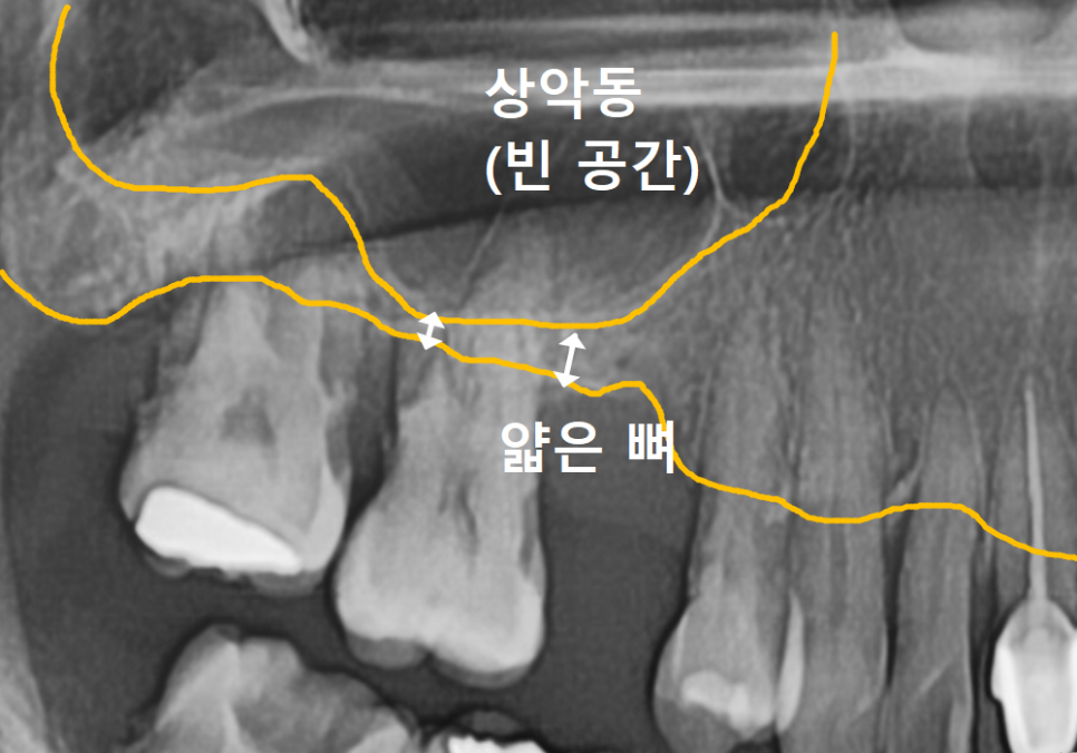 고덕동 스케일링 미루다 앞니 어금니 다 뽑고 임플란트 했습니다. 관련 이미지 16