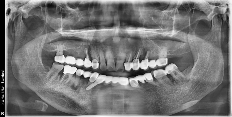 A Pimple Outside the Gums: Bridge Retreatment Implant Case Due to Bone Loss image 3