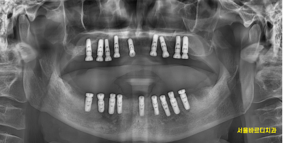 고덕역  치과 틀니쓰다 위아래 전악 임플란트 재건했습니다. 관련 이미지 9