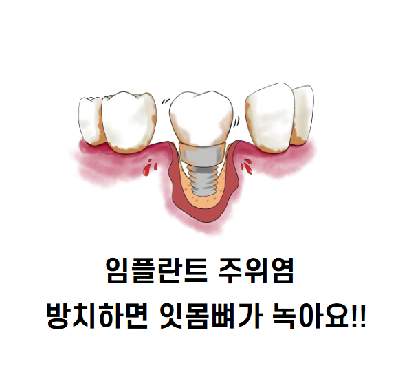 고덕동 임플란트 점검을 꼭! 받으러 와야하는 3가지 이유 관련 이미지 5