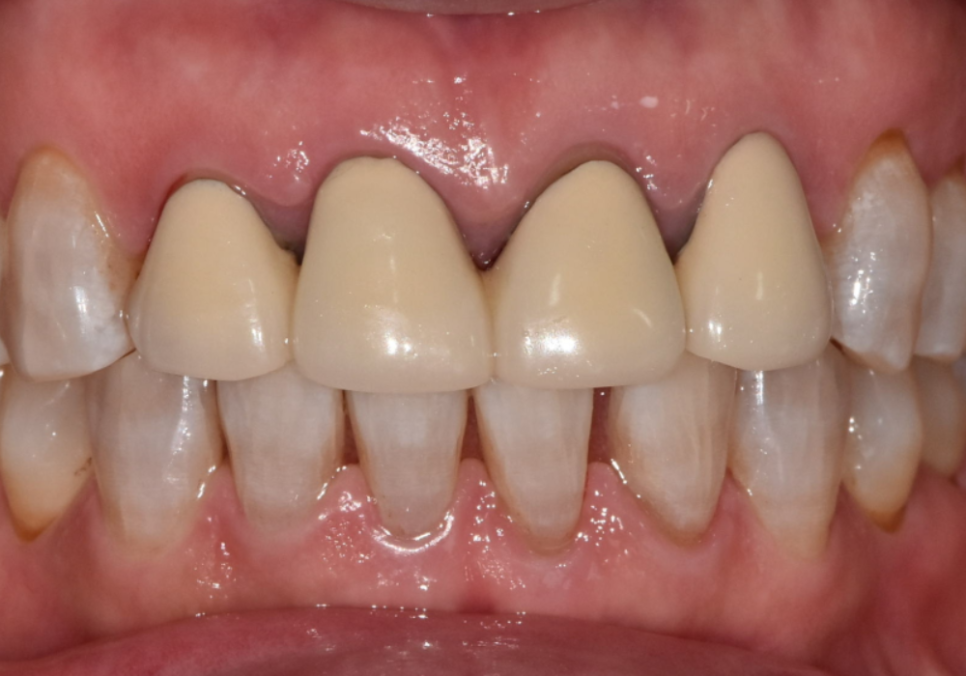 명일동 치과, 잇몸이 검게 변했다면? 앞니 변색 원인은 바로 관련 이미지 3