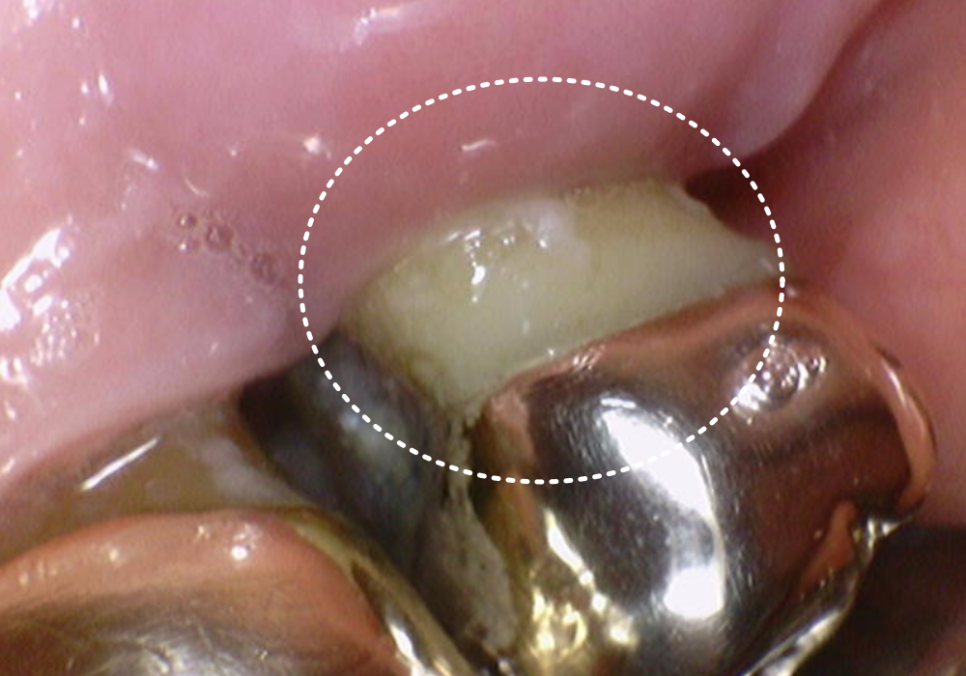 강동구 잇몸 퇴축으로 뿌리 드러난 치아, 이대로 둬도 괜찮을까? 관련 이미지 3
