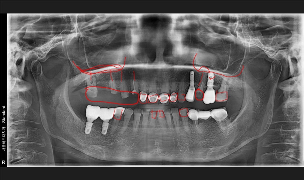 A Case of a 69-Year-Old Who Underwent Immediate Implant Placement After Extraction Due to Tooth Decay in Godeok-dong image 9